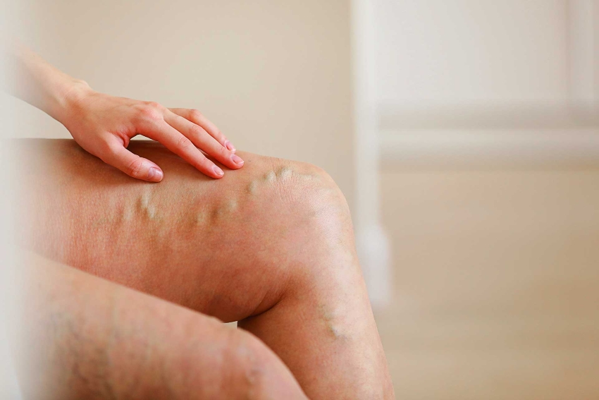 Insurance Covered Vein Treatment Vein Treatment Costs Guttenberg, Hudson County, NJ