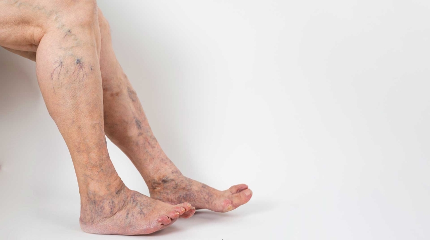 Sclerotherapy Clarivein Venaseal Vein Foam Livingston, Essex County, NJ