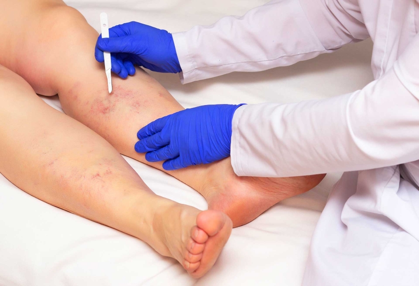 Vein Clinic Vein Center Vein Treatment Care Center Union, Union County, NJ