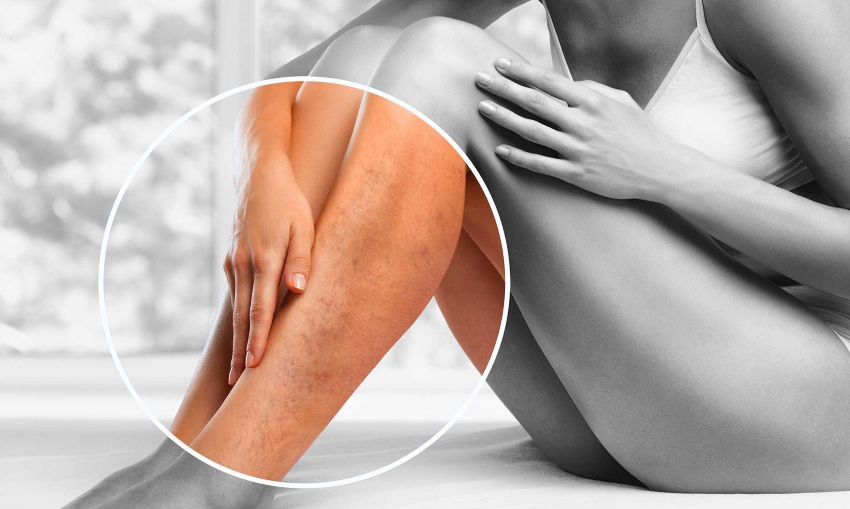 Vein Treatment Vein Removal Top Vein Treatments Ringwood, Passaic County, NJ