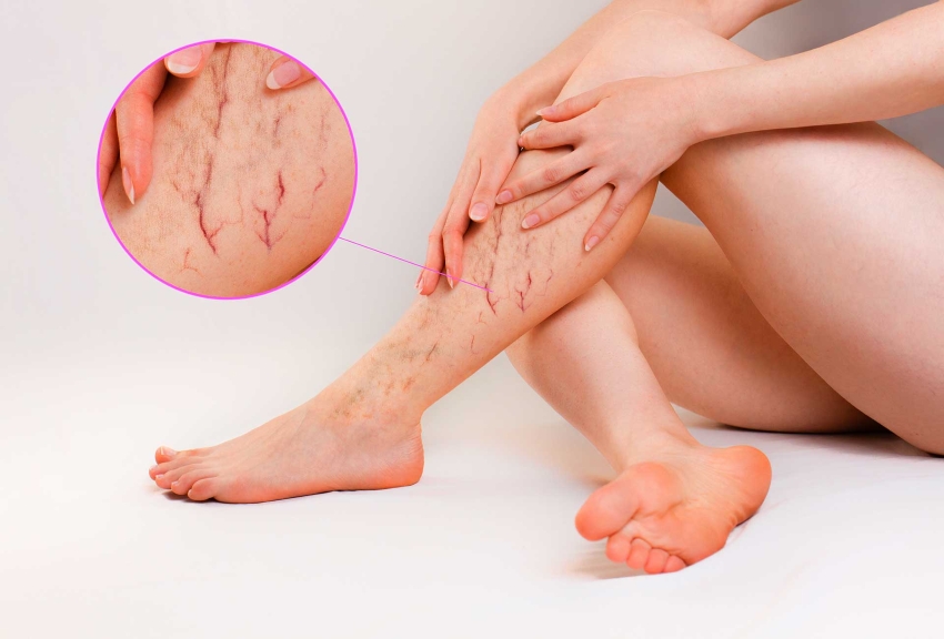 Vein Treatments Spider Veins Varicose Veins Care Morristown, Morris County, NJ