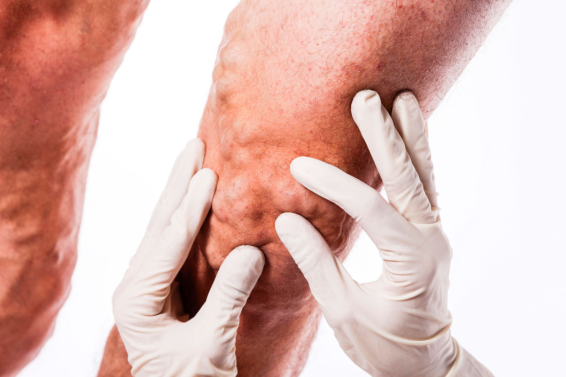 Varicose veins symptoms including leg swelling and skin discoloration