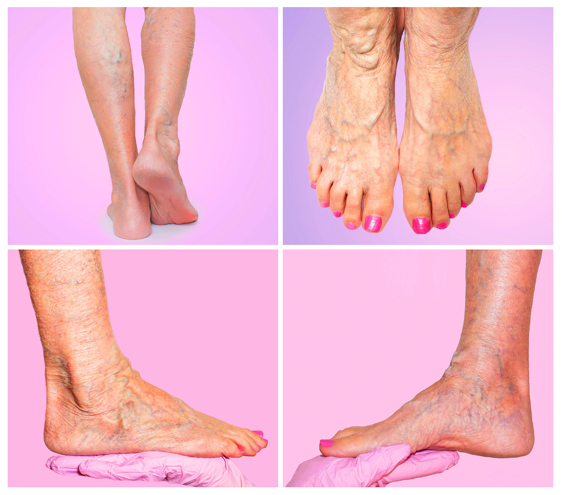 Venous insufficiency symptoms in the legs