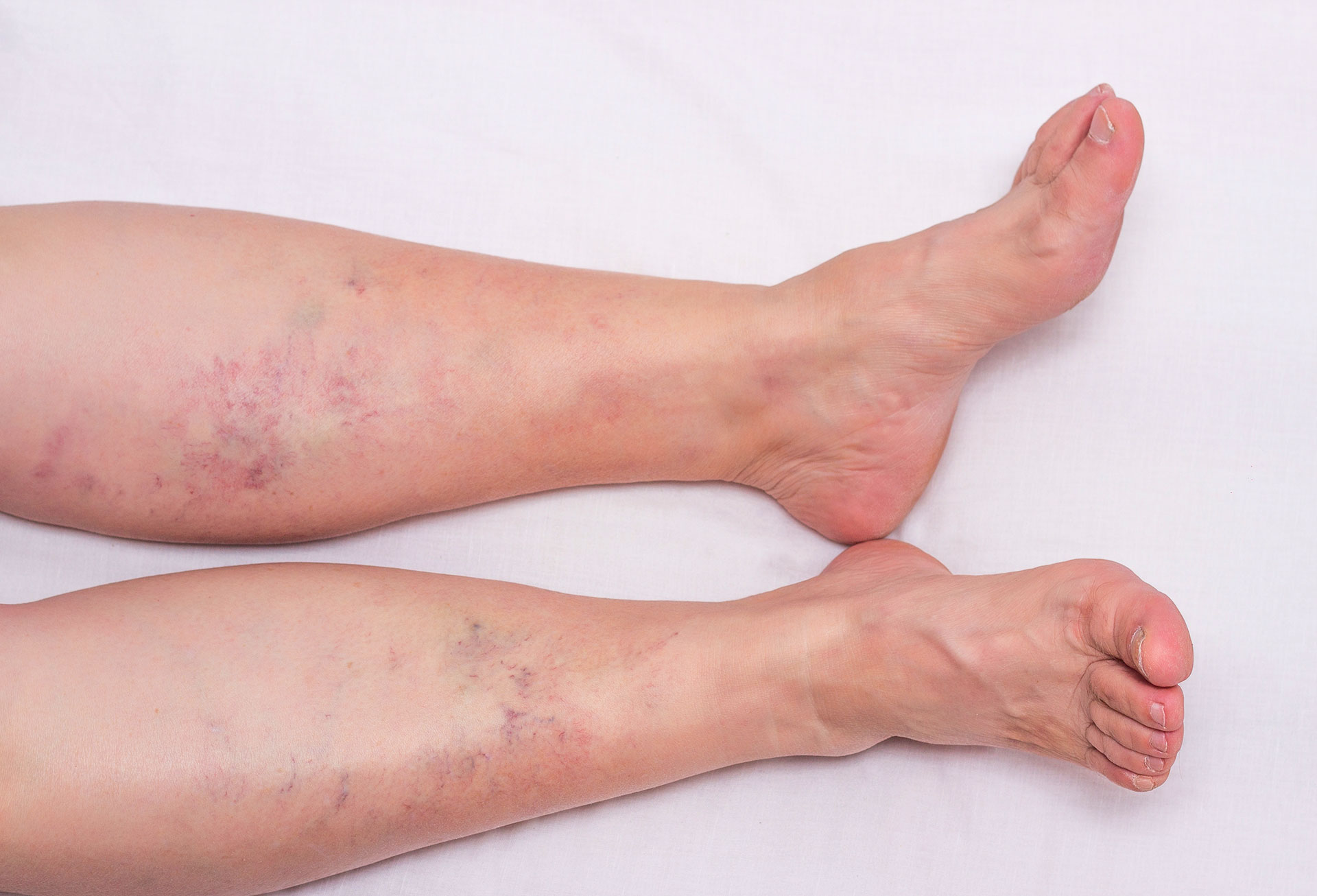 Swollen legs and ankles from blood pooling in legs
