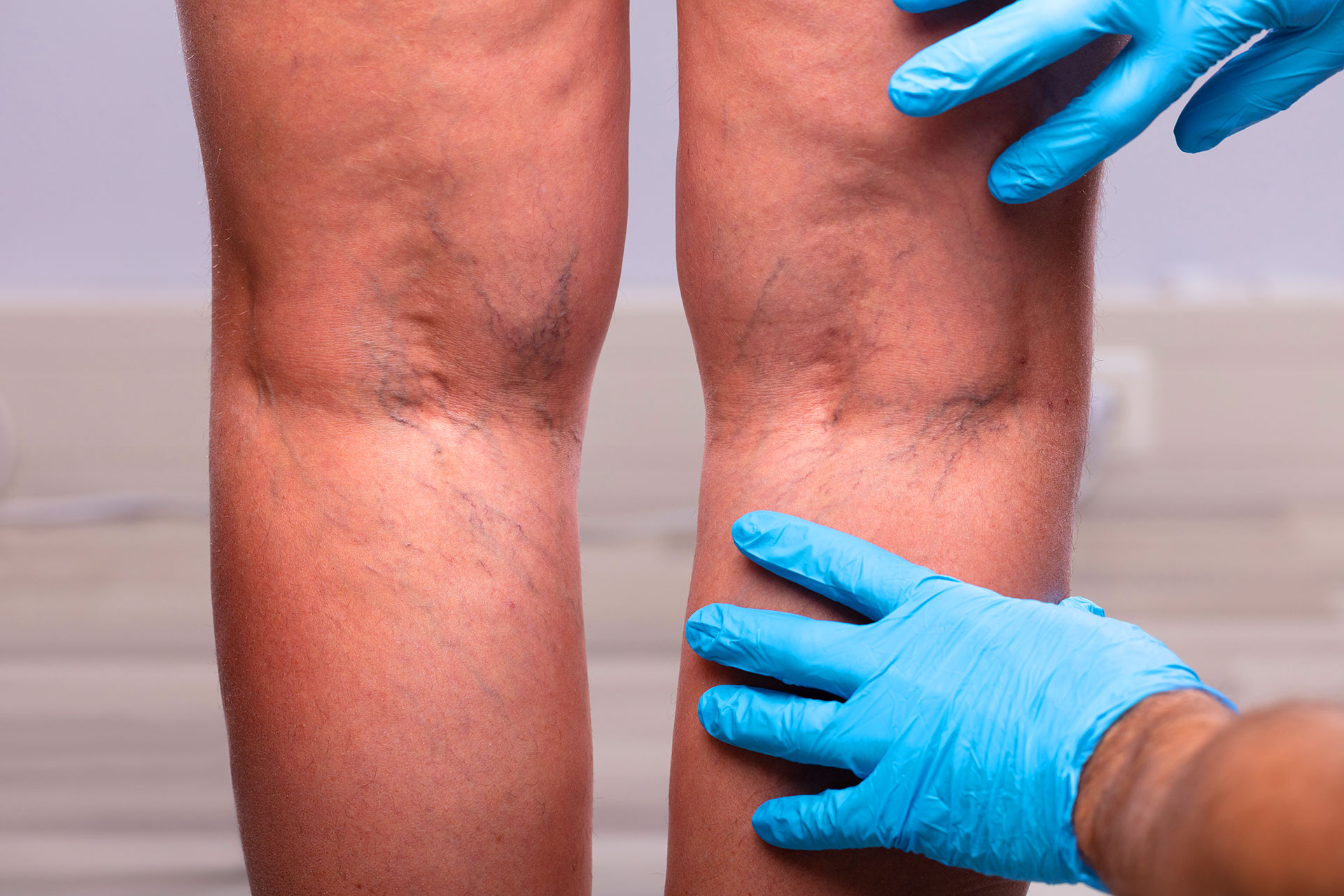 Vein specialist consulting with patient about varicose vein treatment options