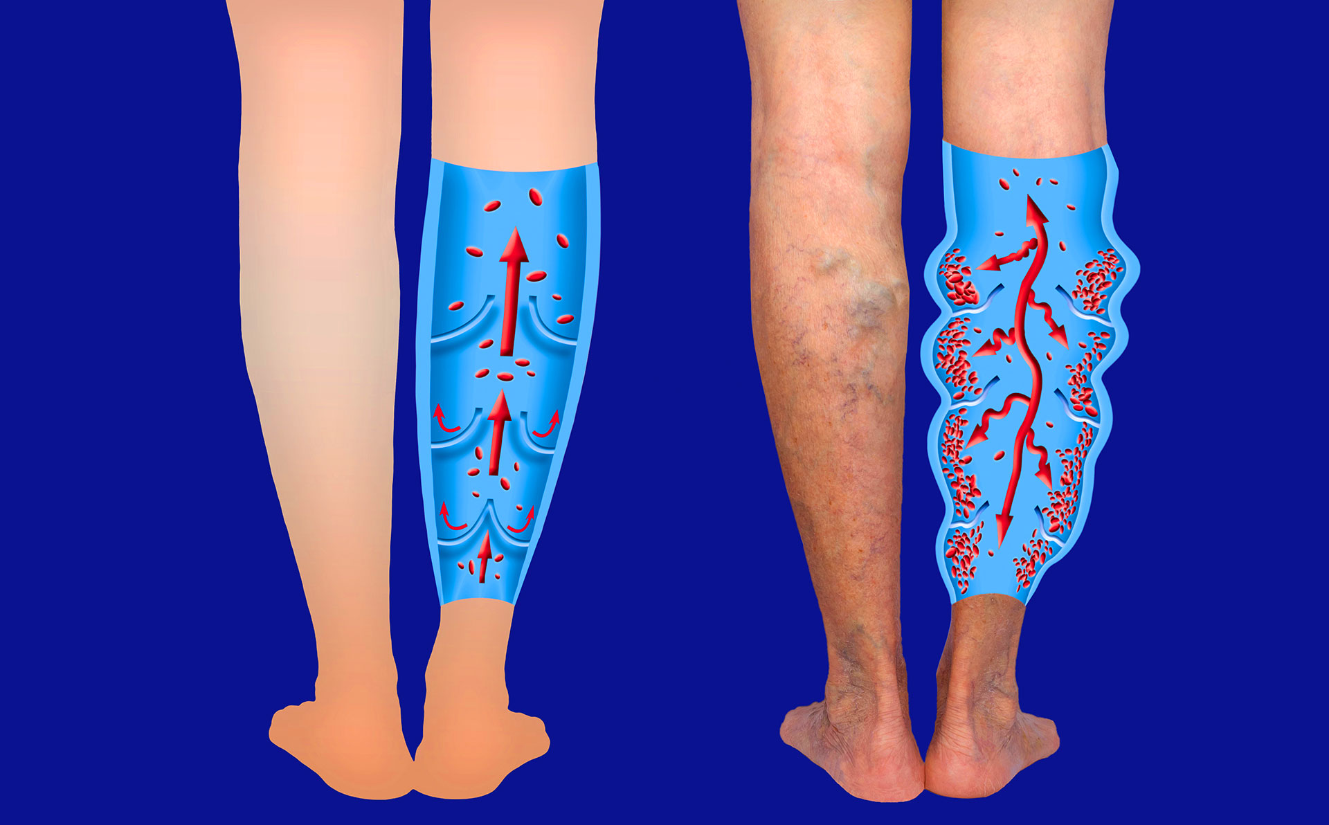 Visible varicose veins on legs associated with weekly leg aching and venous insufficiency