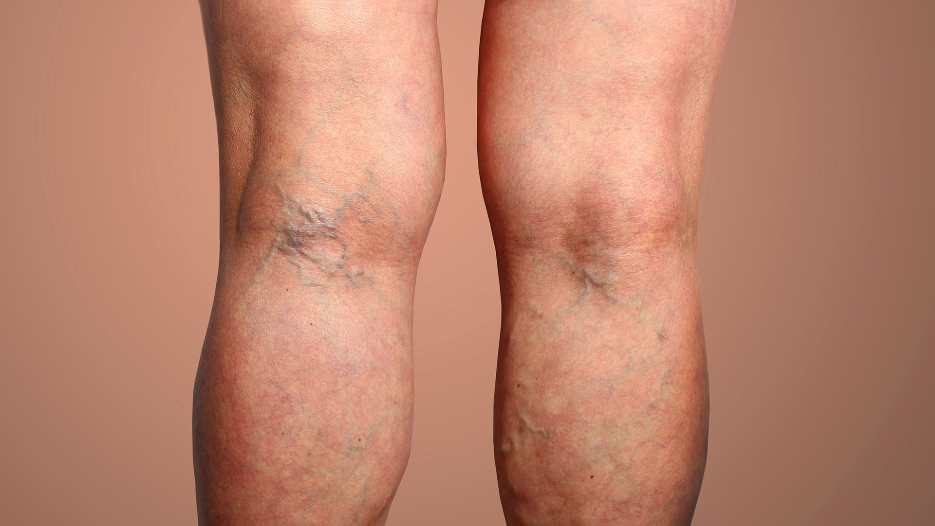 Visible varicose veins on the leg that worsen when left untreated