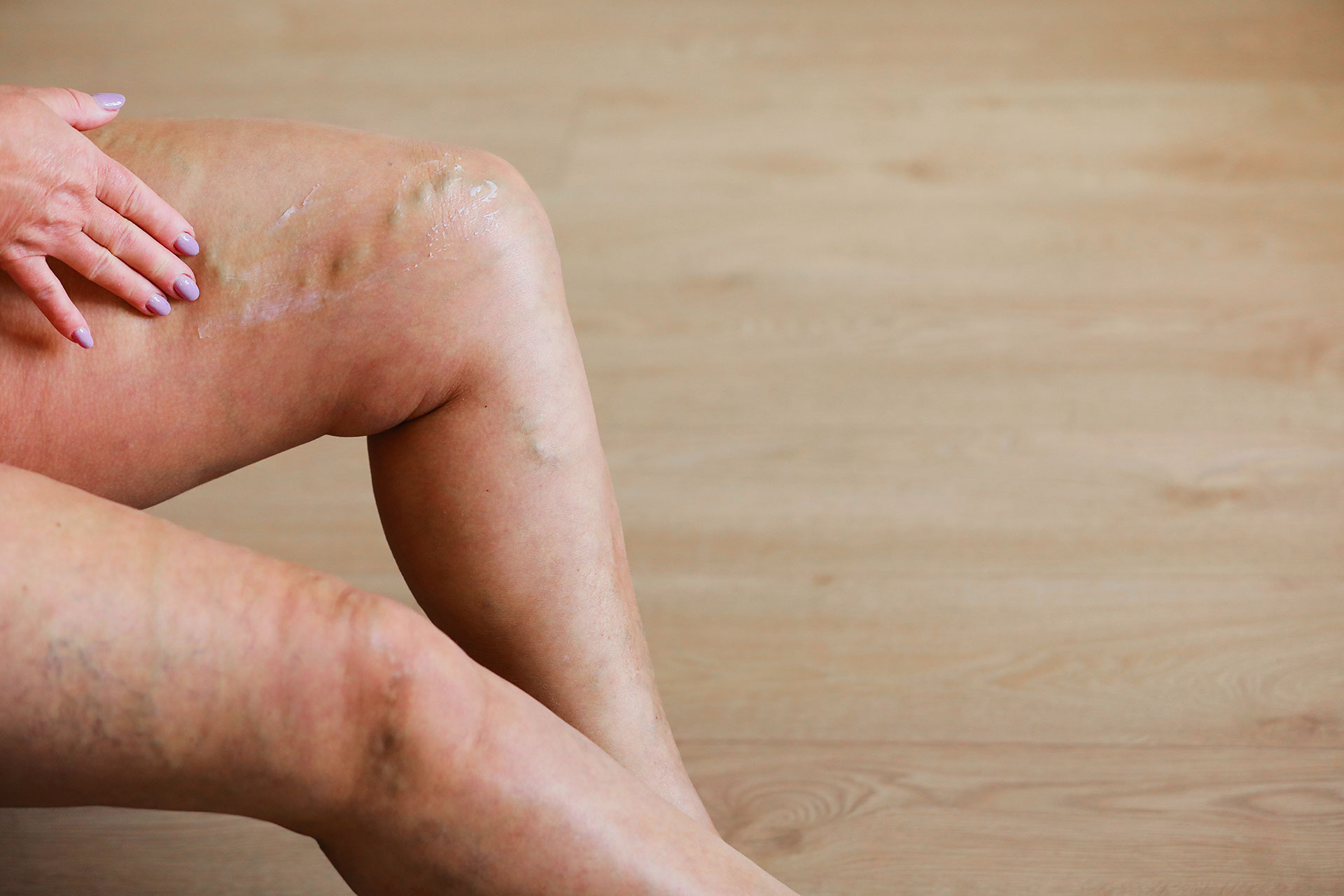 Close-up of bulging varicose veins on the back of the leg