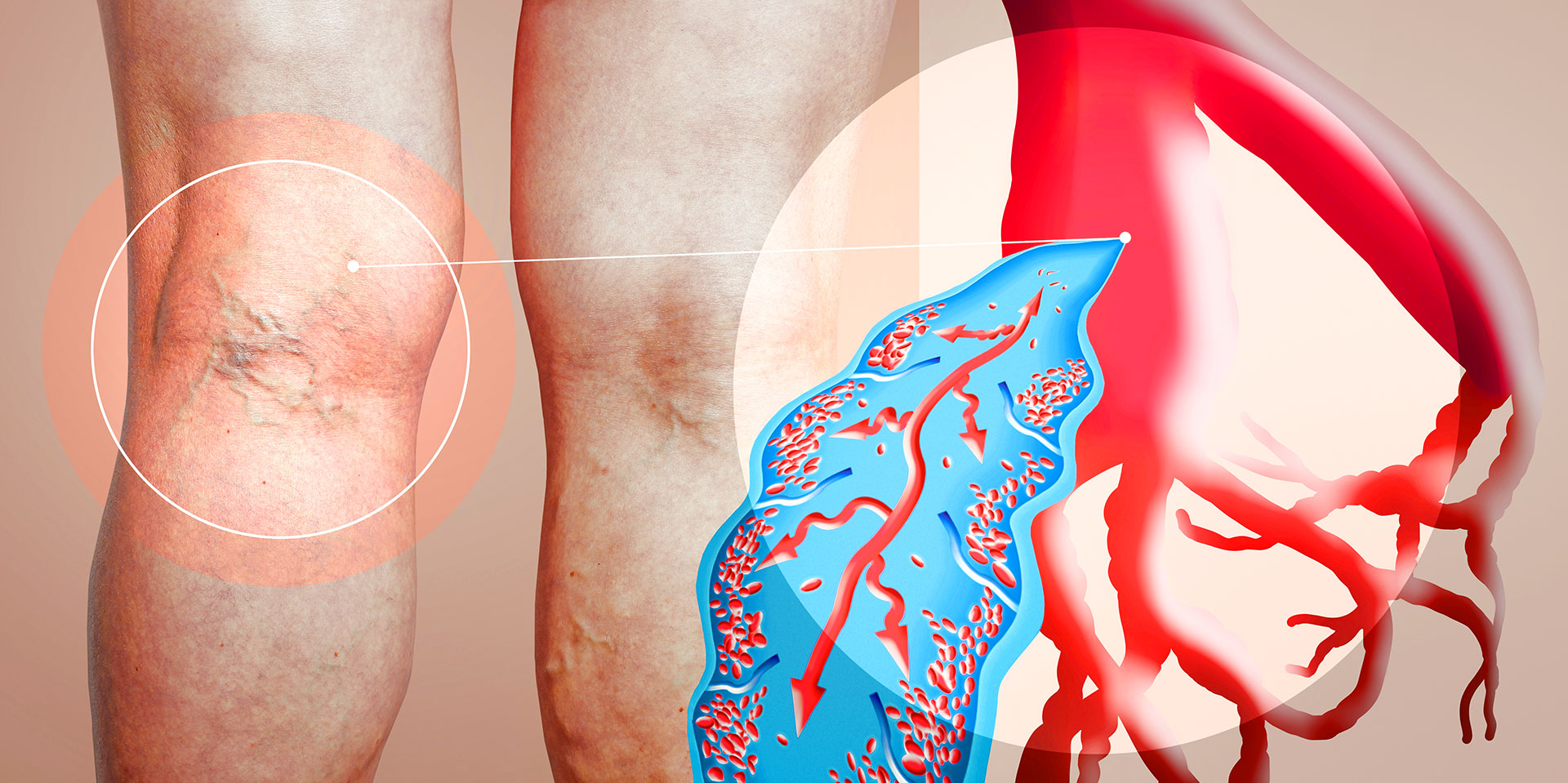 Swollen lower leg with visible varicose veins from venous insufficiency