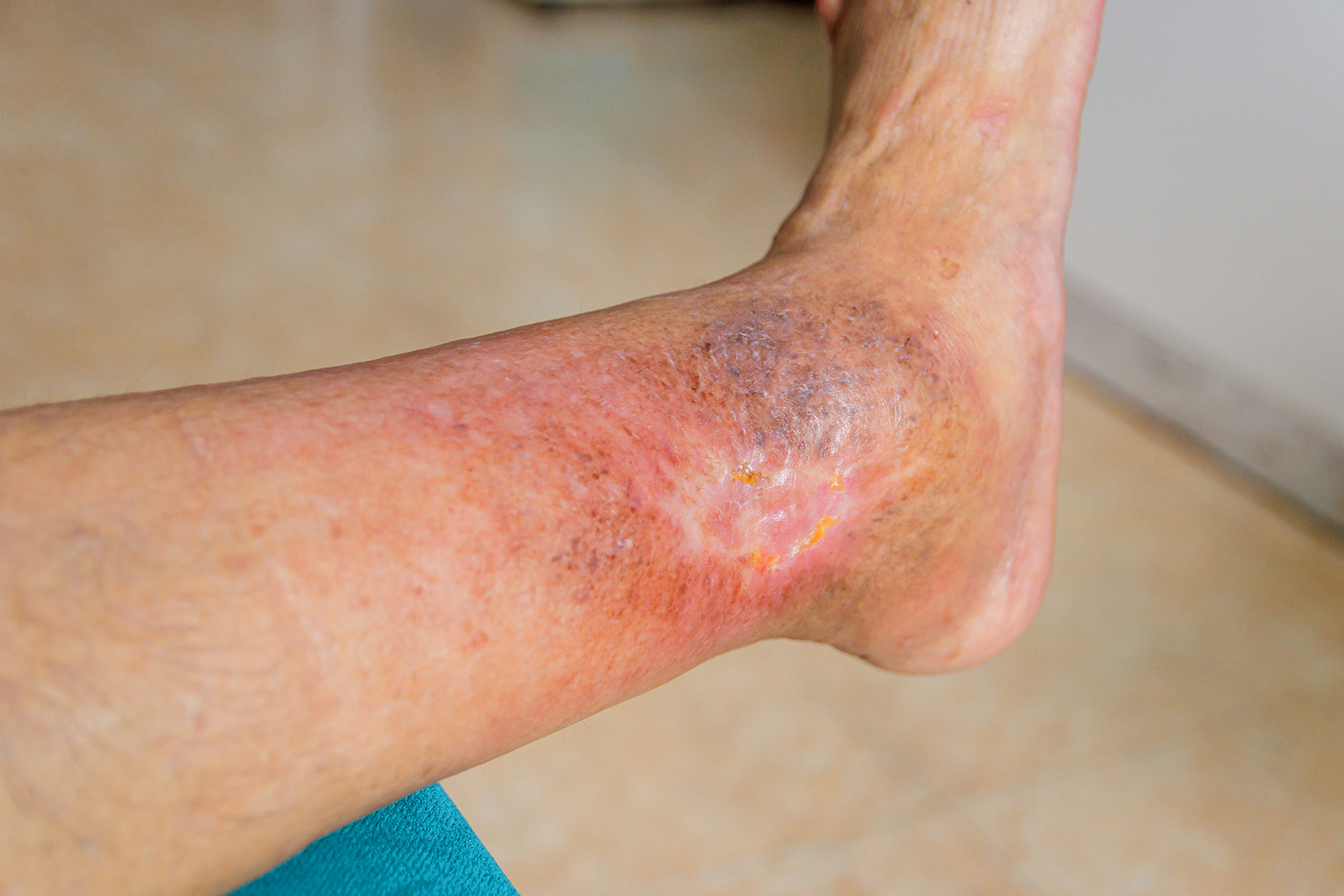 Venous ulcer on the lower leg caused by chronic venous insufficiency