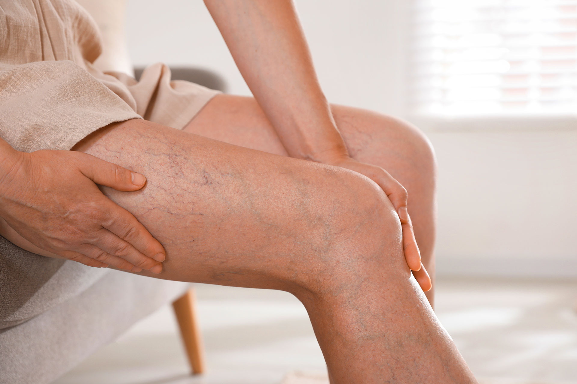 Visible varicose veins on legs caused by prolonged standing