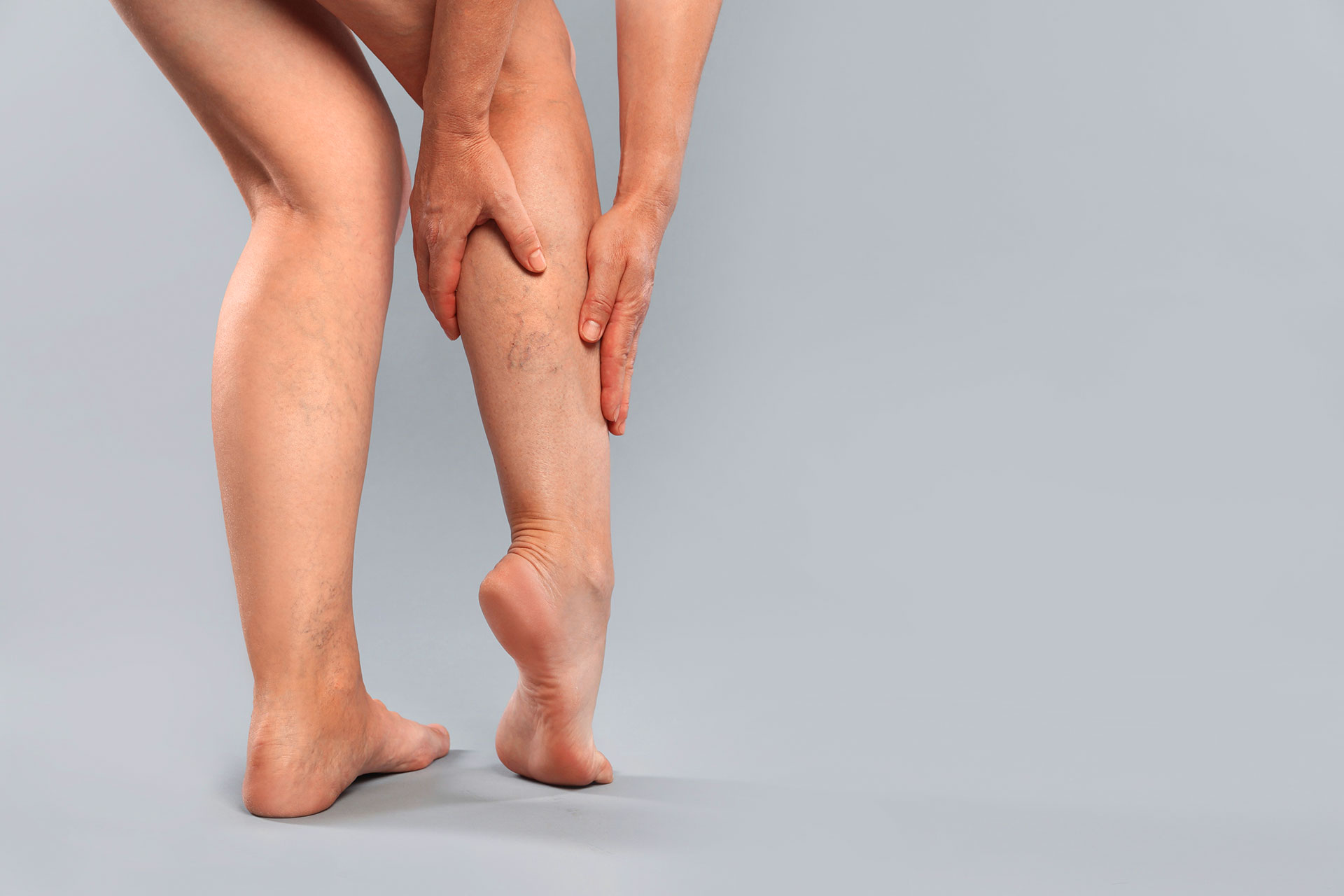Varicose veins on the leg that cause Monday morning leg aching and weekly vein pain