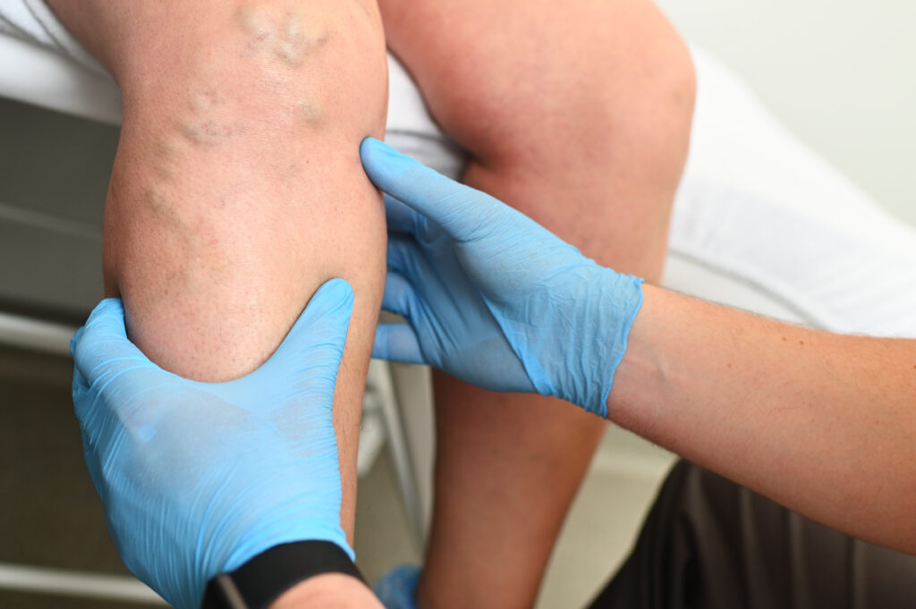 Medical professional in gloves examining a patient's leg with visible varicose veins