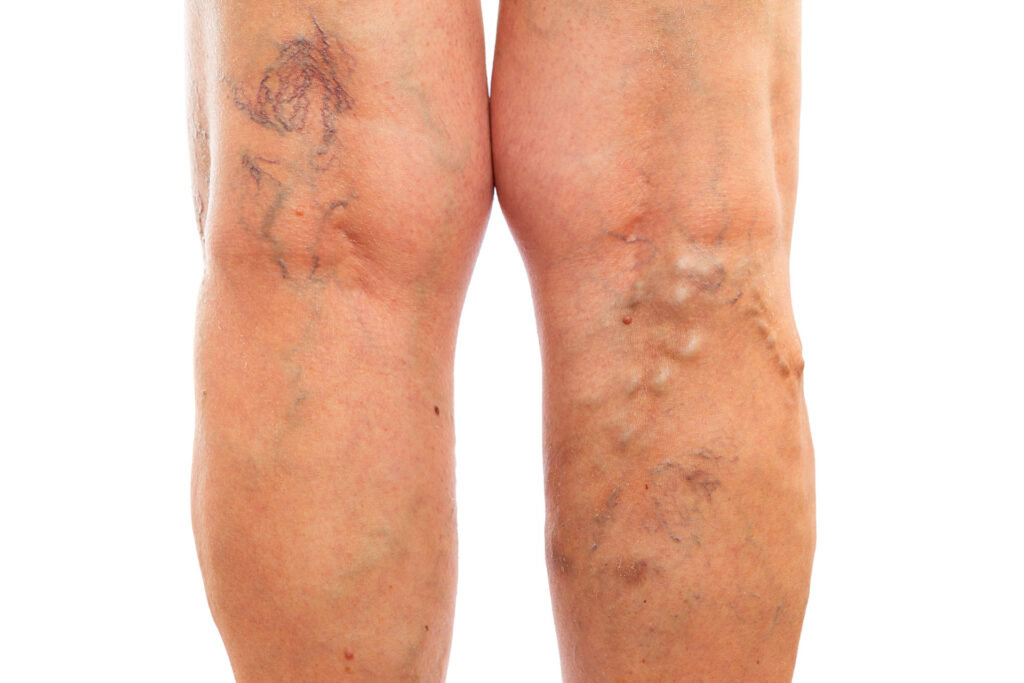 visible vein