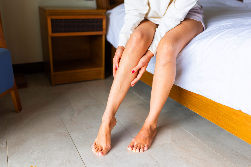 Woman sitting on bed holding painful leg with visible varicose veins