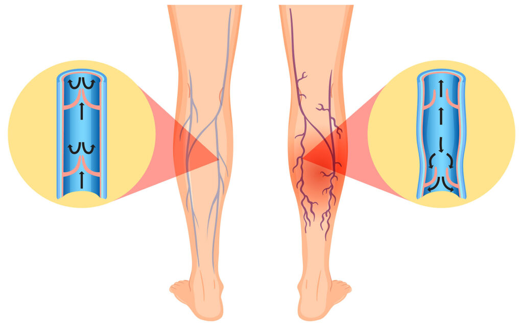 Medical illustration showing blood flow in healthy and varicose veins