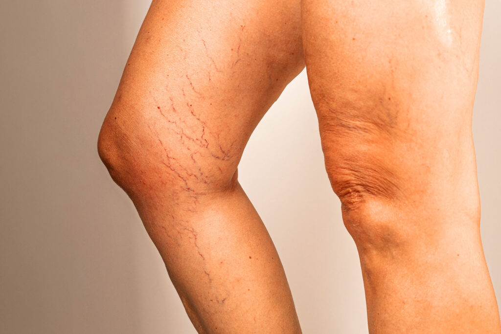 Close-up of elderly woman's legs showing spider veins and varicose veins around the knee