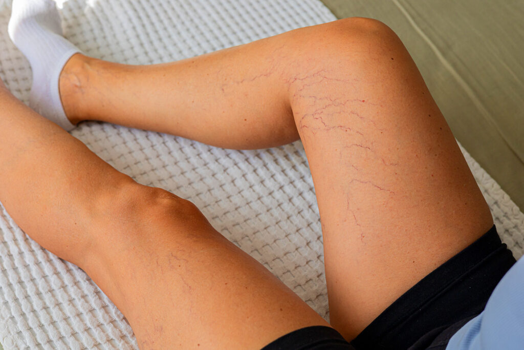 Close-up of spider veins and telangiectasias on woman's thigh during medical examination