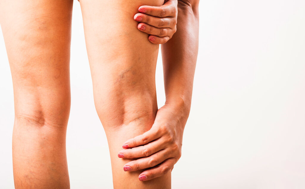 Why Do Varicose Veins Hurt? Pain Causes and Relief Tips