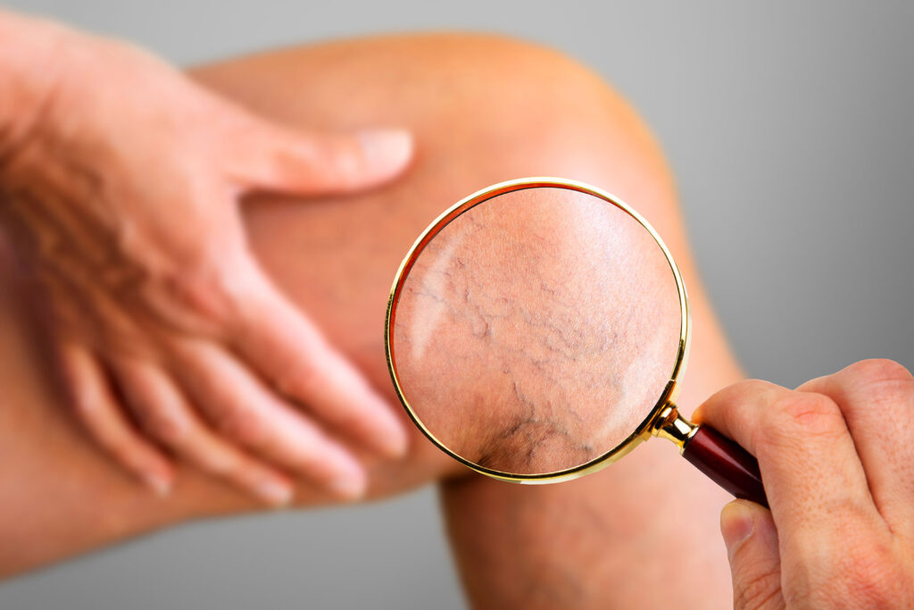 Hand holding magnifying glass over skin with visible spider veins