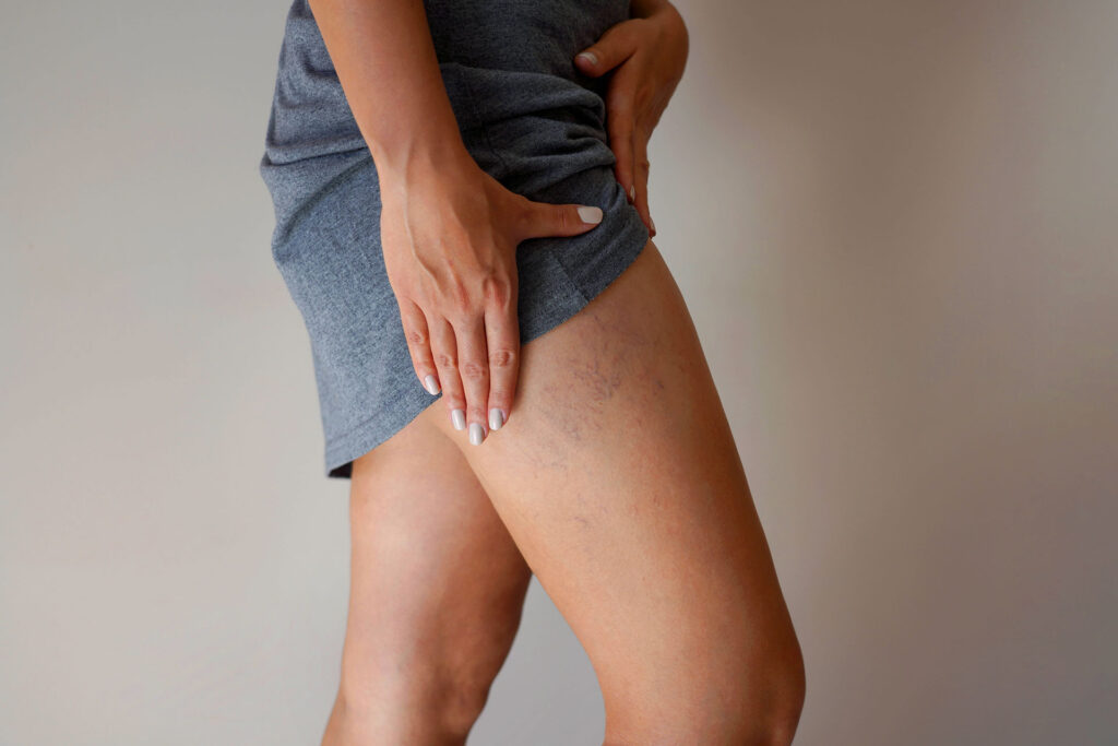 Woman in gray dress touching spider veins on her upper thigh