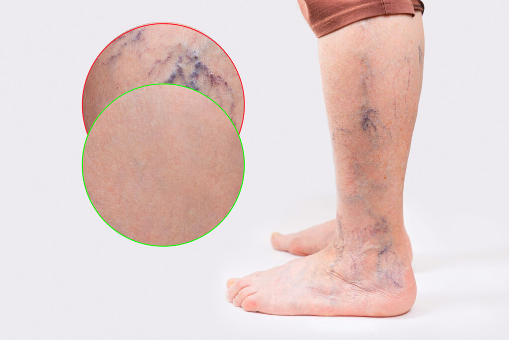 Lower leg showing spider veins with circular magnified skin area
