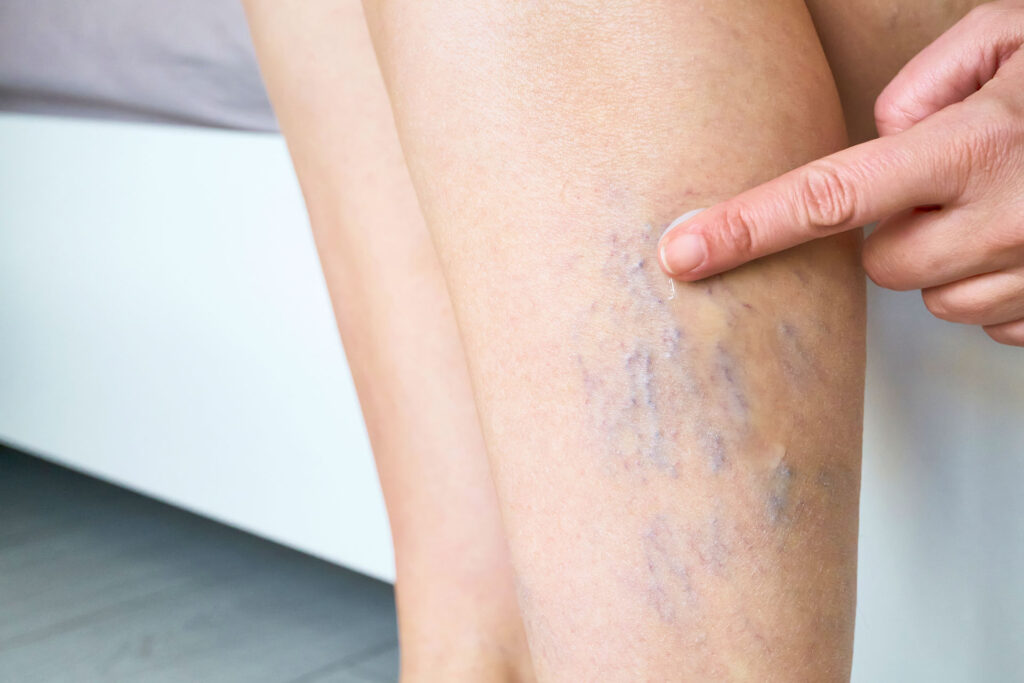 Person applying cream to spider veins on their lower leg