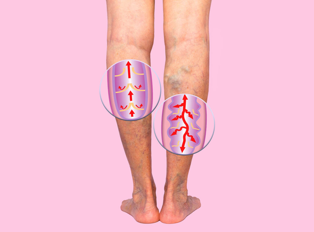 Illustration of human leg veins showing normal and abnormal blood flow