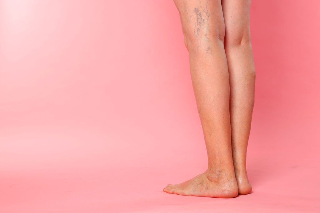 Side view of a woman's legs showing prominent varicose veins