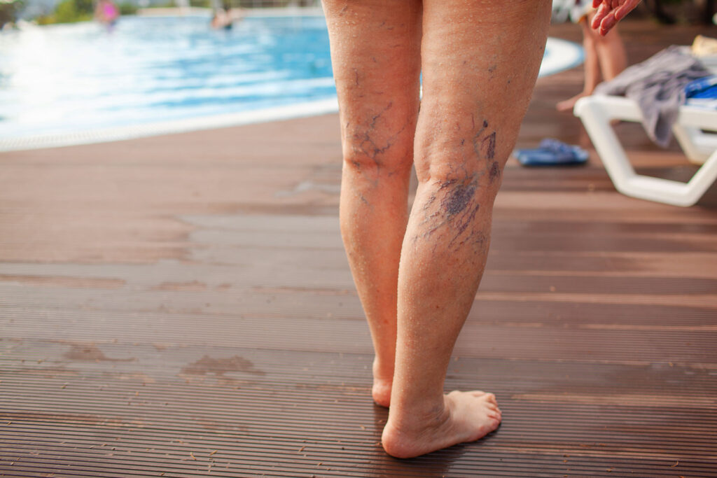 Person standing by a pool with visible spider veins on legs