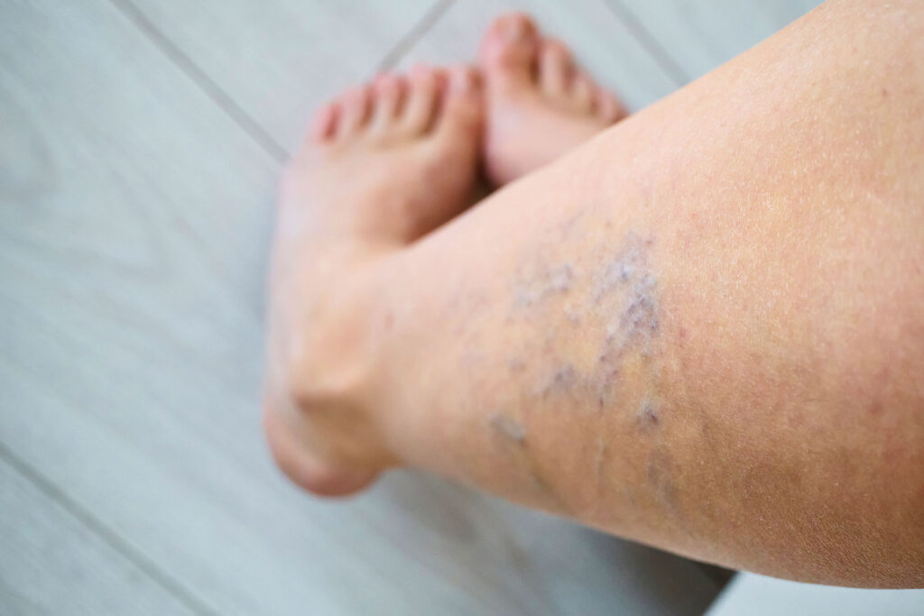 Leg with visible spider veins near bare feet on floor