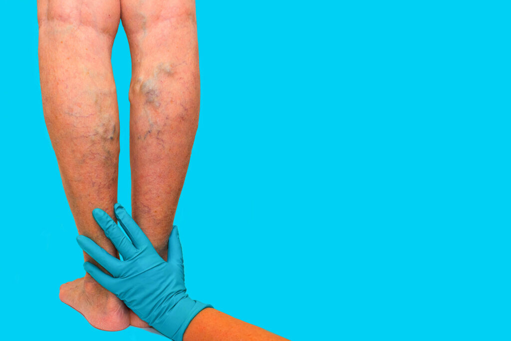 Doctor in gloves examining patient legs with prominent varicose veins