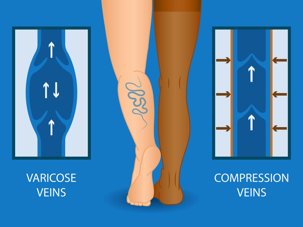 Medical illustration comparing varicose veins with poor blood flow versus healthy veins with compression stocking therapy