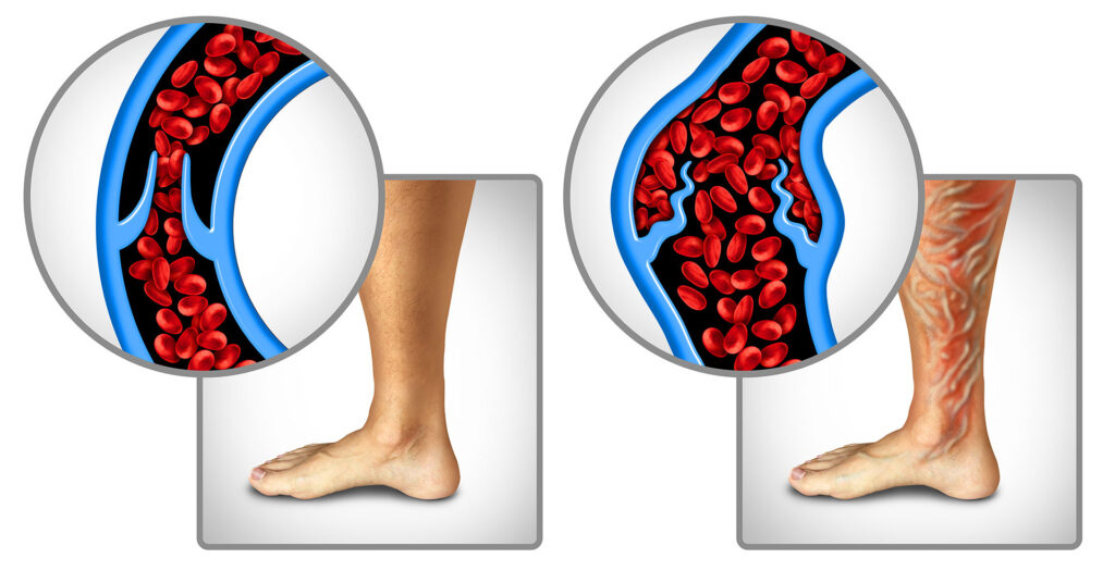 Medical illustration comparing healthy vein to leg with varicose veins