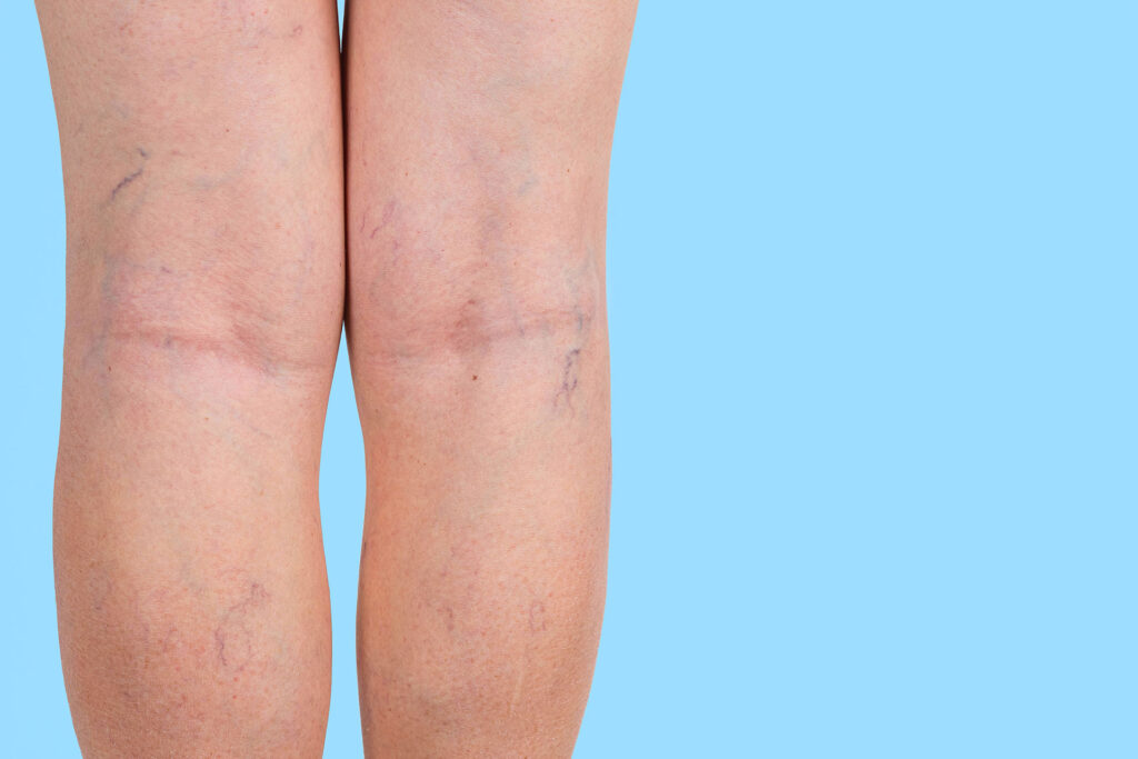 Close up of legs showing visible spider veins on skin