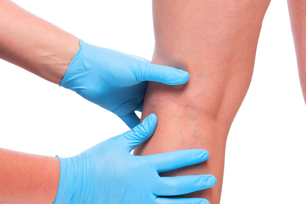 Doctor with blue gloves examining spider veins on patient leg