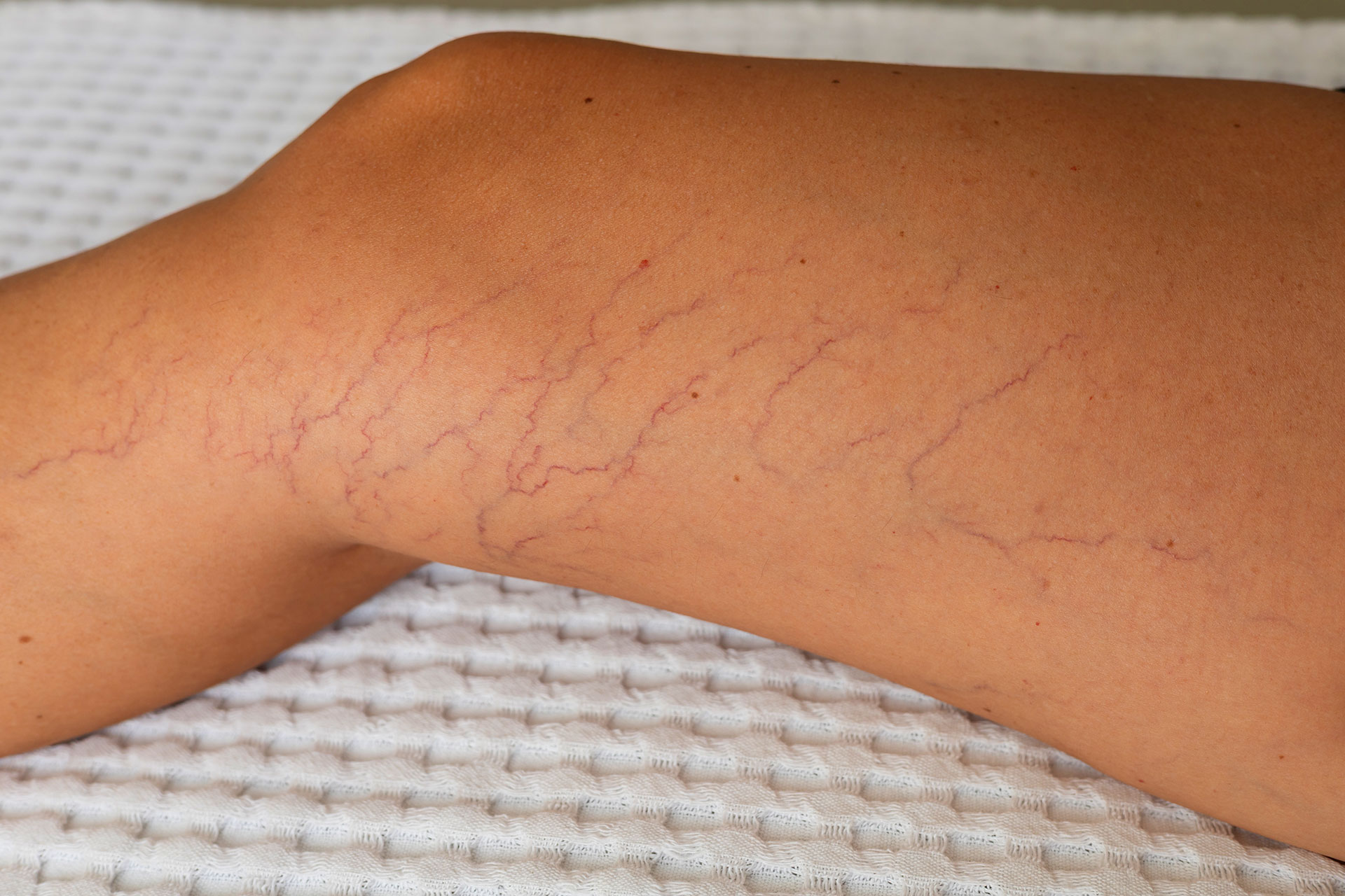 Popped Blood Vein? Symptoms, Causes, and When to Worry