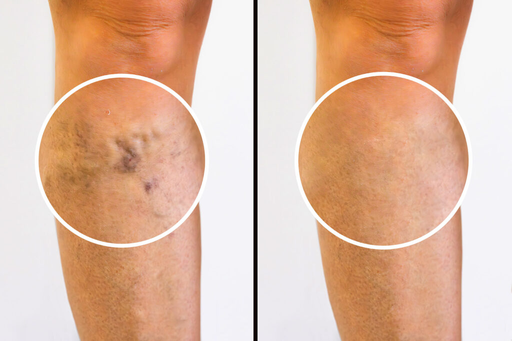 Before and after comparison of leg varicose vein treatment