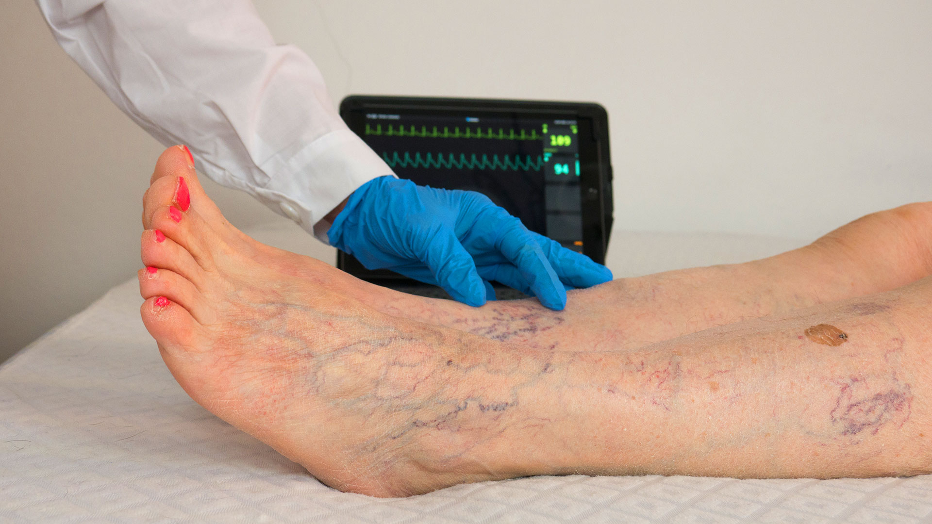 Woman examining spider veins on upper thigh area
