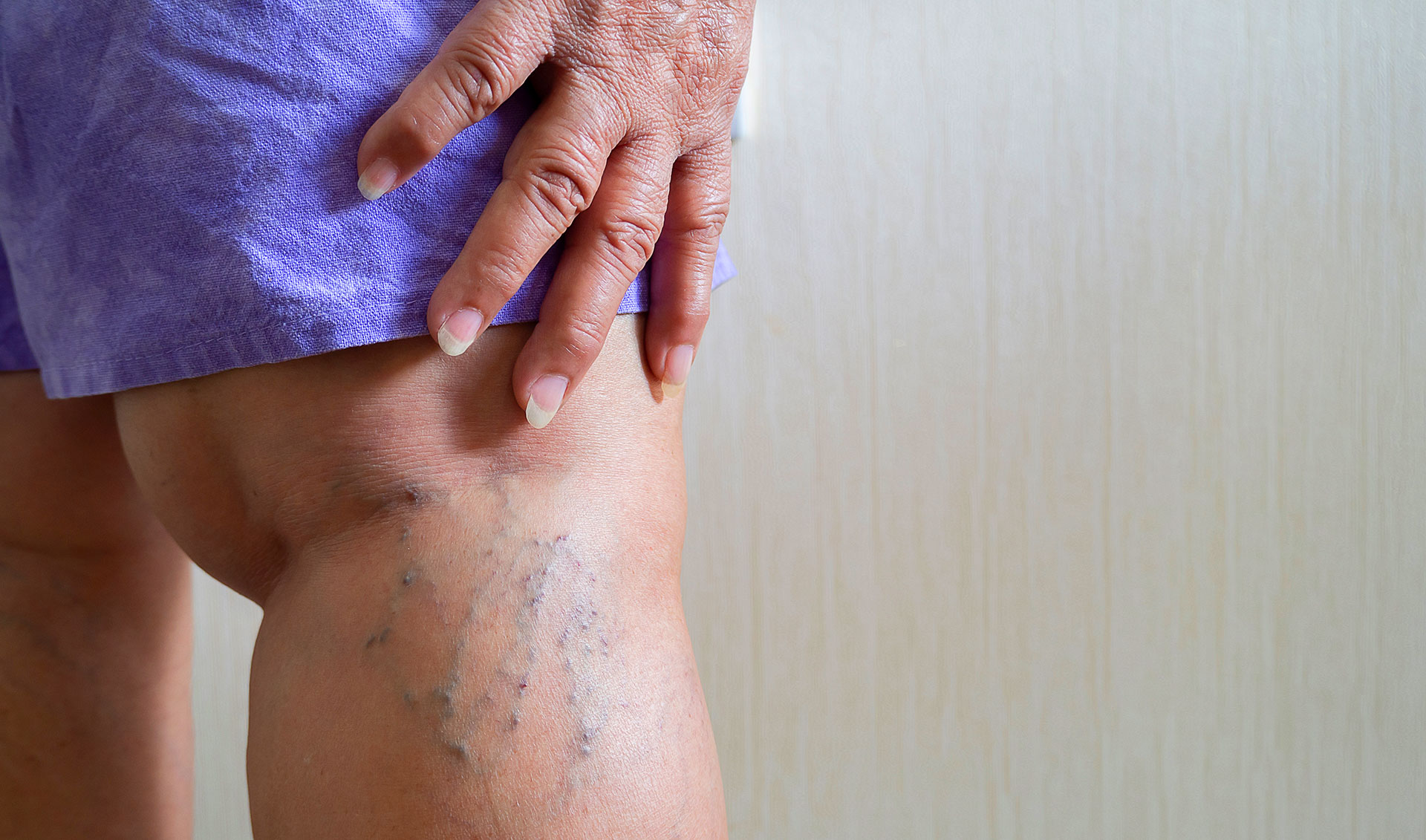 Elderly woman touching varicose veins behind her knee