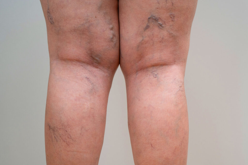 Close-up of prominent varicose veins on legs showing circulation issues.