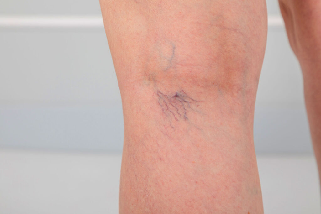Detail view of small spider veins on a patient's leg.