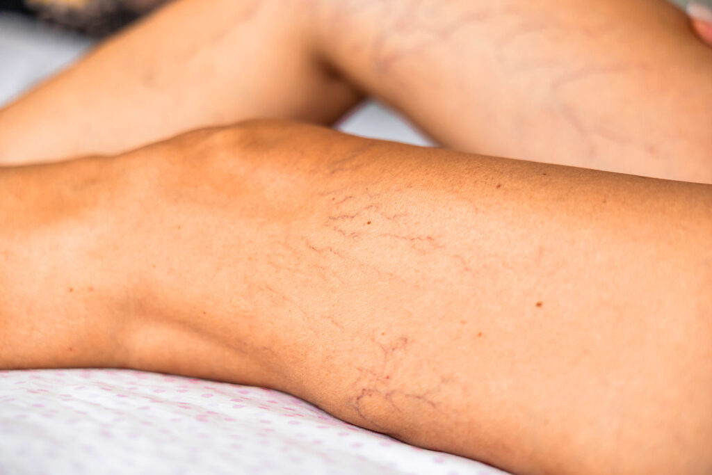 Close-up of spider veins on a leg showing skin texture and vascular patterns.