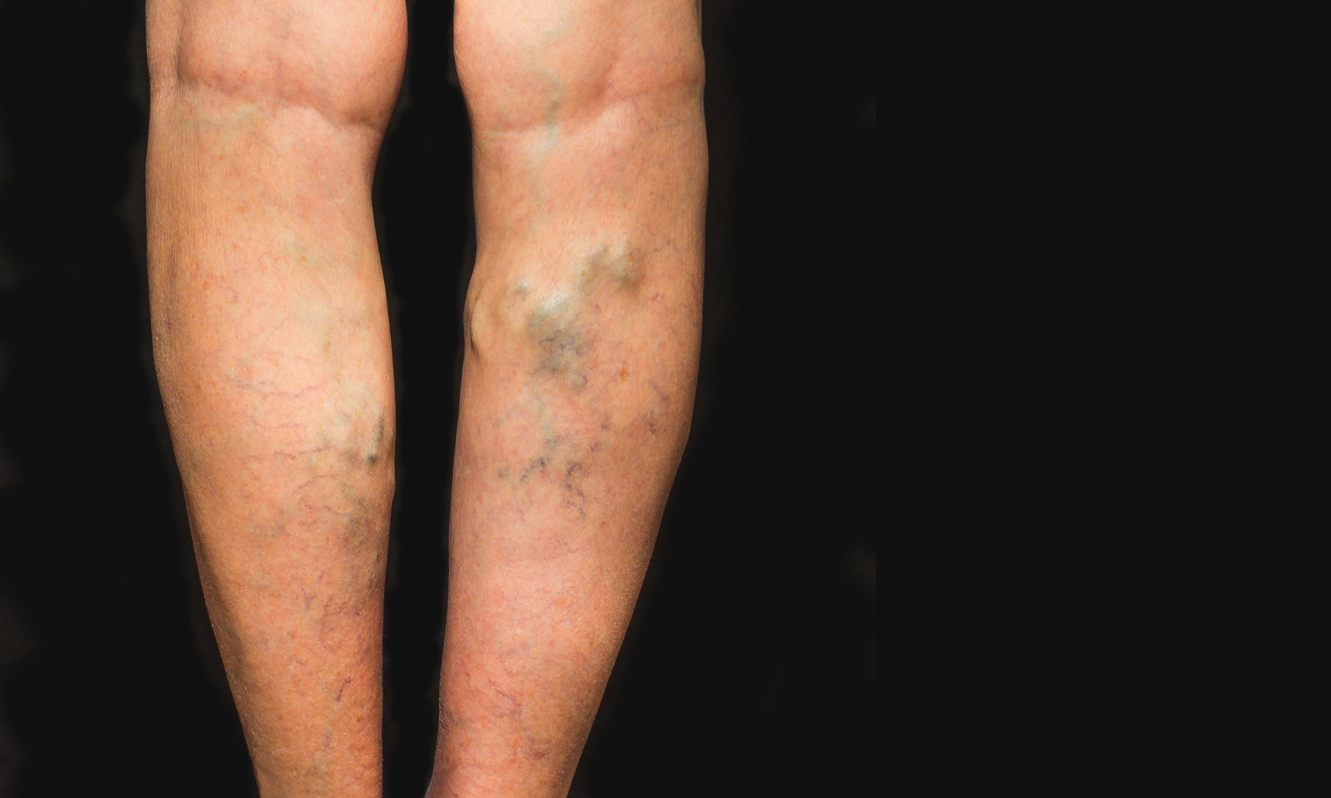 Are Varicose Veins Dangerous or Just Cosmetic?