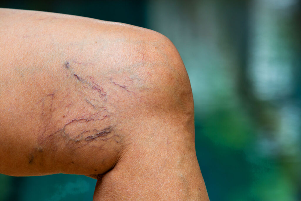 Close-up of varicose veins along back of leg