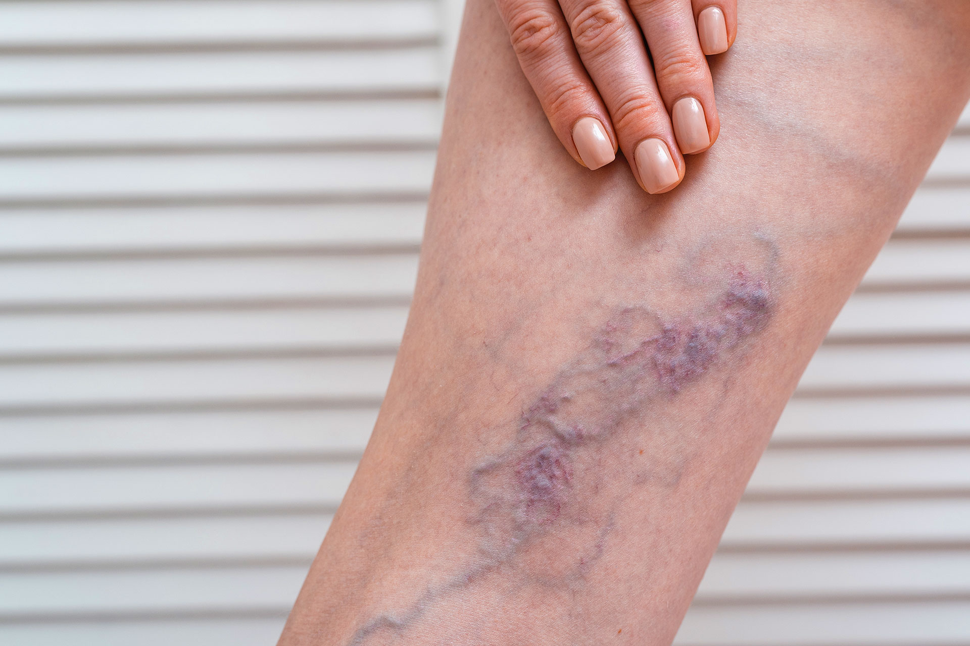 How to Minimize Varicose Veins Before They Get Worse