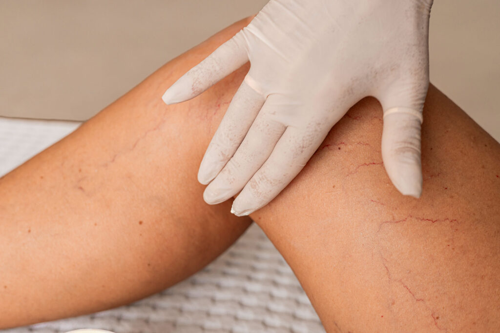 Gloved hand applying cream to leg with spider veins