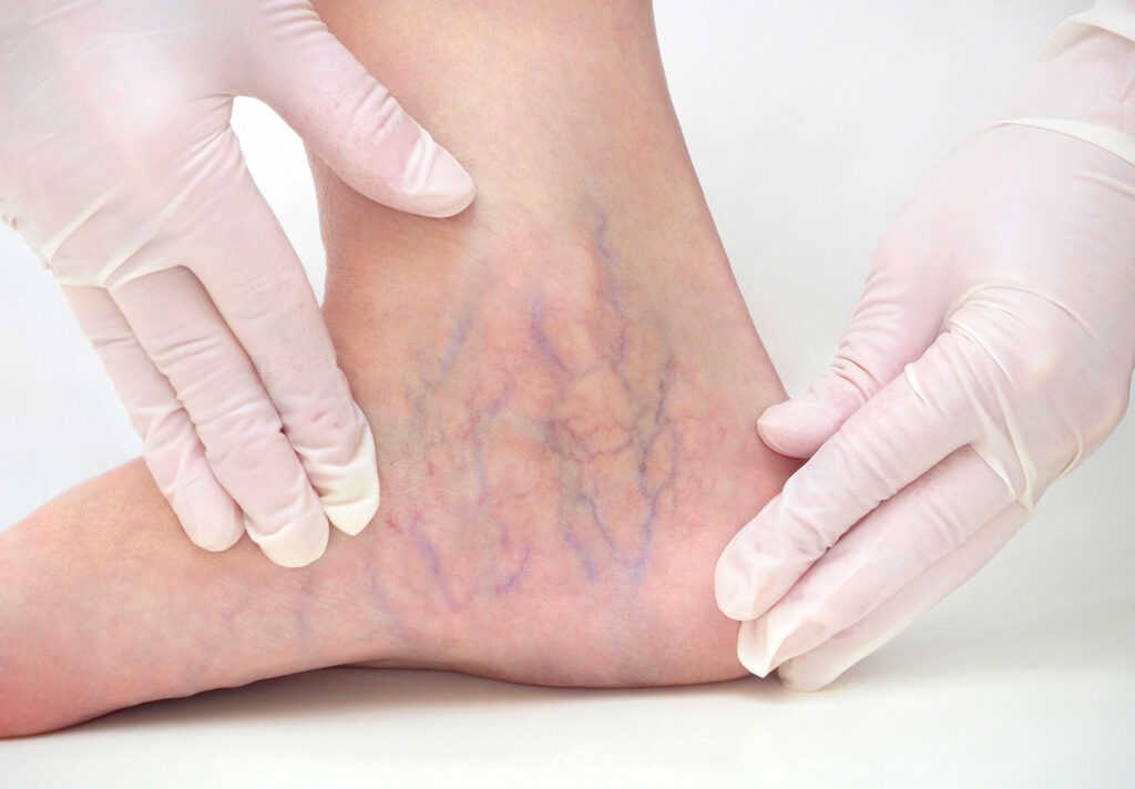 Gloved hands examining varicose veins on patient ankle