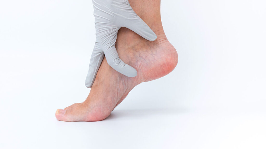 Close-up of spider veins on back of ankle