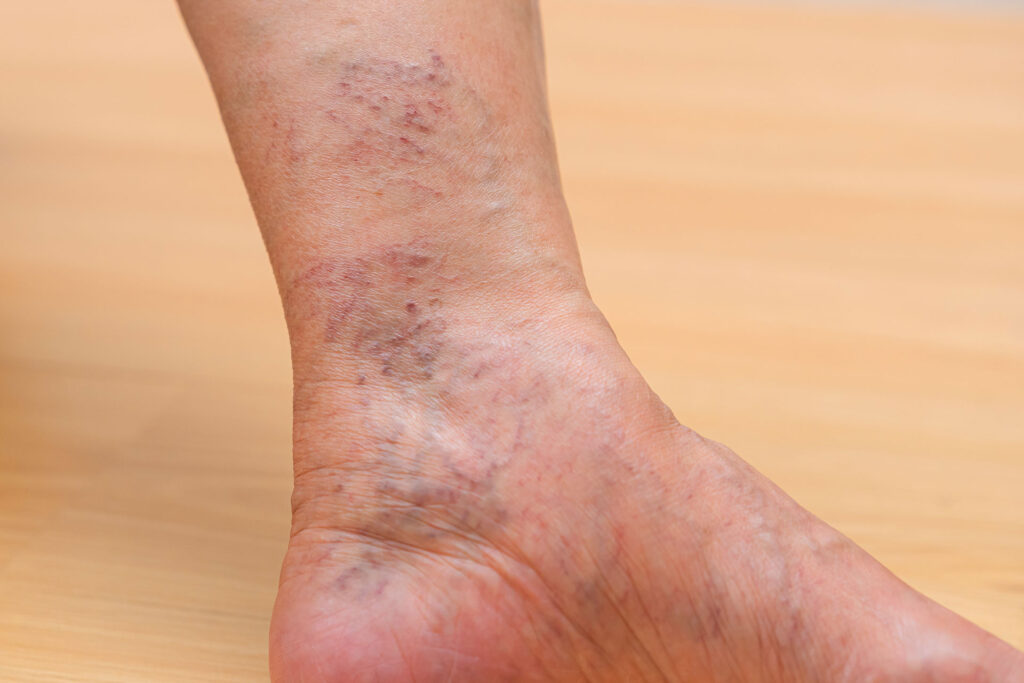 Close-up of spider veins on back of ankle